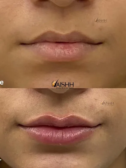 My goal with lip fillers is always harmony and balance. Here, I carefully added subtle volume and enhanced the natural shape of the lips, avoiding an overdone look. The result is fuller, more defined lips that perfectly complement the patient's features.