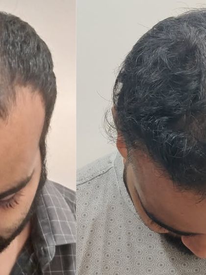 This top-down view clearly shows the transformation from a thinning crown to a full head of hair. This angle is critical for assessing the success of a crown-focused hair transplant.
