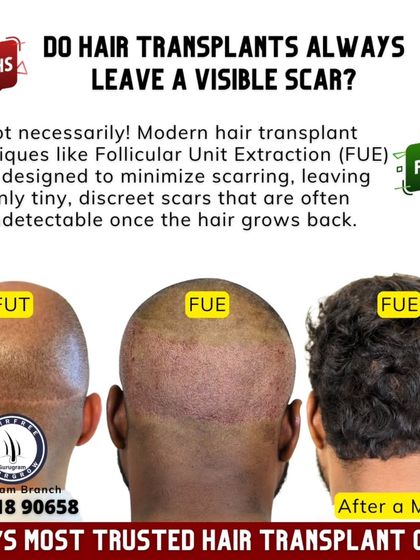 **Myth:** Hair transplants always leave a visible scar. **Fact:** Not with modern techniques. The FUE method I use leaves only tiny, dot-like scars in the donor area that are virtually undetectable once the hair grows back.