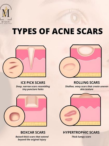 An educational graphic showing the different types of acne scars. Identifying your scar type is the first step toward finding the right treatment.