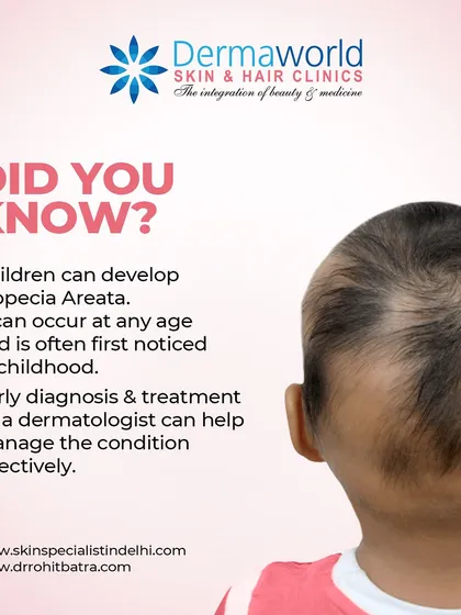 Did you know that hair loss conditions like Alopecia Areata can also affect children? It often appears as patchy hair loss and can be distressing for both the child and parents. I believe early and gentle intervention is key to managing the condition effectively.