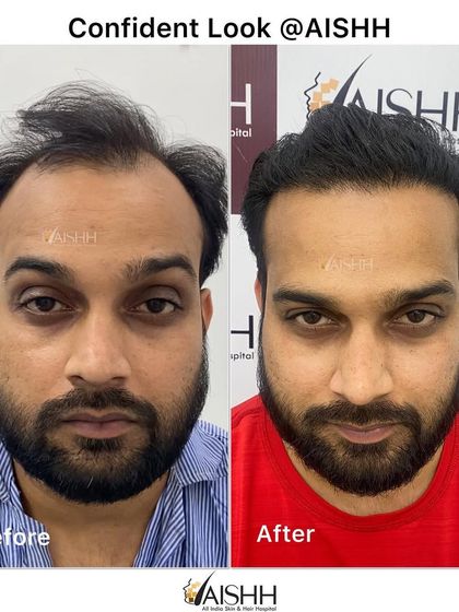 A frontal view of a patient's before-and-after transformation. Notice the restored hairline and the significant increase in density, giving him a confident new look.