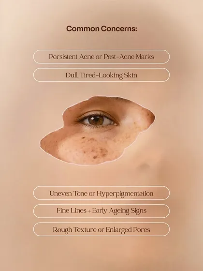 This graphic lists common concerns that indicate you might benefit from a chemical peel. These include persistent acne or post-acne marks, dull skin, uneven tone, fine lines, and rough texture or enlarged pores.