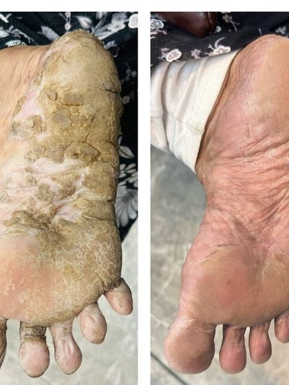 Soothing Severe Palmoplantar Keratoderma. This condition causes painful, thickened skin on the feet. This transformation shows the dramatic improvement after a customized treatment plan involving keratolytic agents and intensive moisturizing therapy.