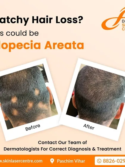 I find that showing results is often the most reassuring step for my patients. Here you can see a clear before and after of a patient treated for Alopecia Areata, or patchy hair loss, showing significant hair regrowth and coverage after treatment at our clinic.