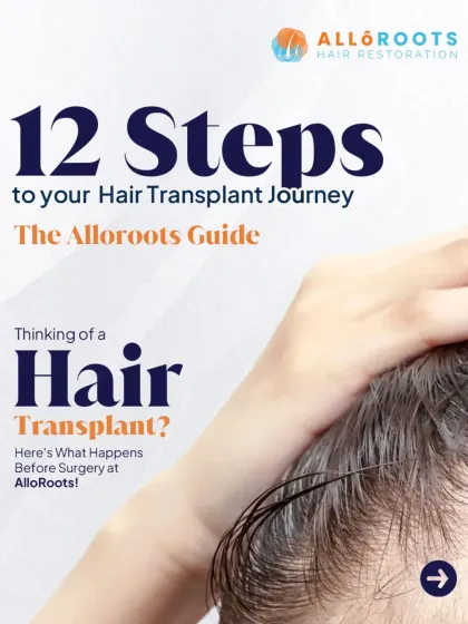 A hair transplant journey can feel overwhelming. I created this 12-step guide to provide a clear, transparent roadmap of what happens before, during, and after your surgery with me. You will be informed and empowered at every stage.