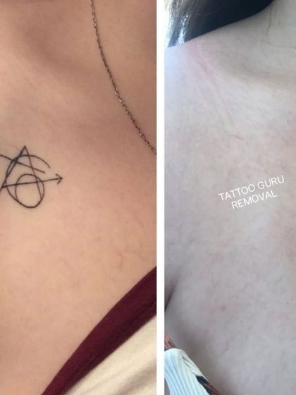 An abstract symbol tattoo removed from the chest. The after photo shows clean skin with no trace of the original fine-line tattoo.
