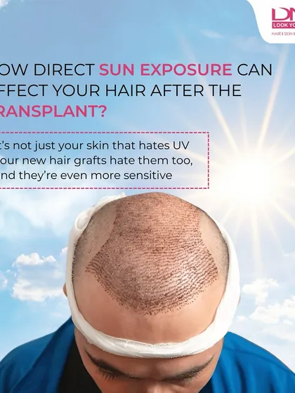 Just had a hair transplant? Don't step into the sun unprotected. Your new hair grafts are extremely sensitive to UV rays, and direct sun exposure can negatively affect the healing process and your final results.