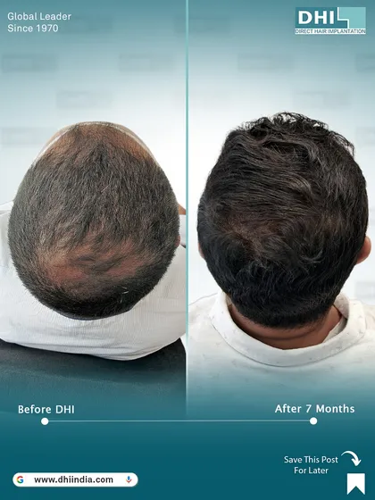 This top-down comparison shows the dramatic improvement in crown coverage for a Norwood Grade III patient after 7 months. Our technique ensures even and dense growth across all treated areas.