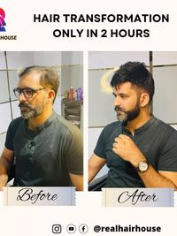 Non-Surgical Hair Replacement