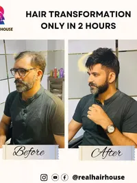 Non-Surgical Hair Replacement