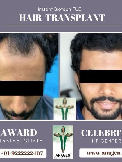 This before and after photo showcases our expertise in frontal hairline design using the Instant Biotech FUE technique, resulting in a natural and dense outcome.