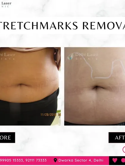Another example of successful stretch mark removal. The treatment focuses on stimulating the skin to repair itself, gradually fading the marks and blending them with the surrounding skin.