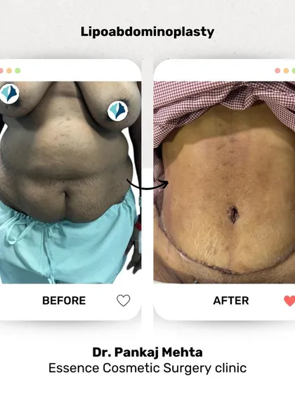 This patient underwent a lipoabdominoplasty, a procedure where we combine liposuction with a tummy tuck. This allows us to remove stubborn fat deposits from the abdomen and flanks while also tightening loose skin, resulting in a significantly improved waistline and abdominal contour.
