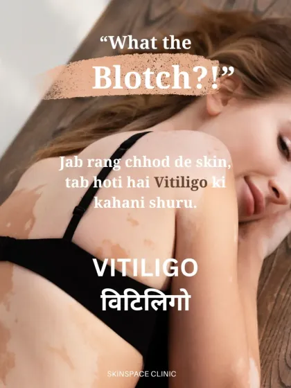 "What the Blotch?!" This is how the story of vitiligo begins, when the skin starts to lose its color. I am here to provide expert guidance and treatment options for this condition.