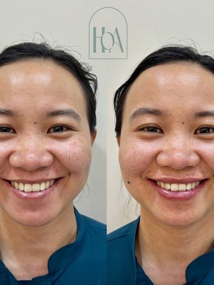 A smiling view of a natural lip filler result. The focus here was on enhancing the shape and providing hydration, which makes the entire smile appear brighter and more youthful.