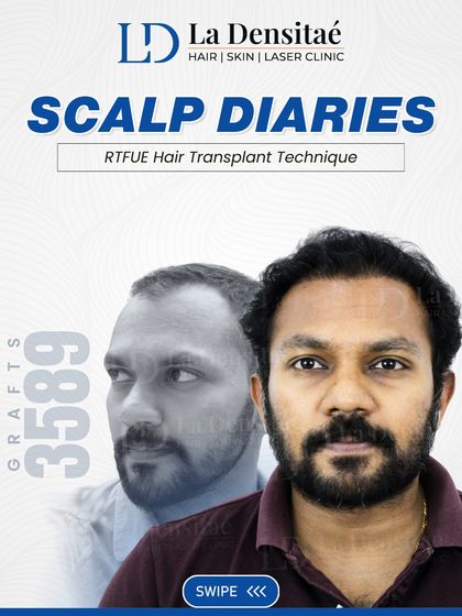 Mr. Mithun’s new, dense hairline was achieved by transplanting 3,589 grafts using the Real-Time Follicular Unit Extraction (RT-FUE) technique. This method ensures high graft survival for a fuller, more natural look.