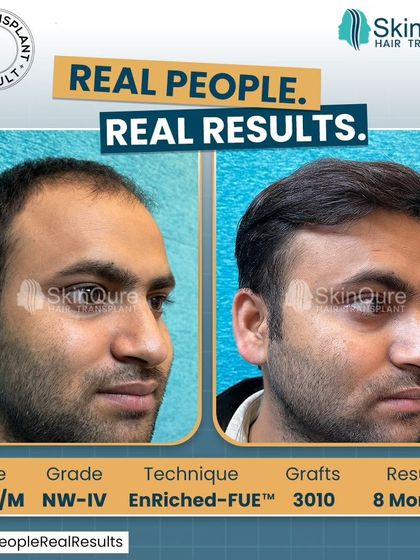 A side-profile view of the 28-year-old patient with NW-IV hair loss. The 8-month result after 3010 grafts shows a natural and dense hairline that enhances his facial features.