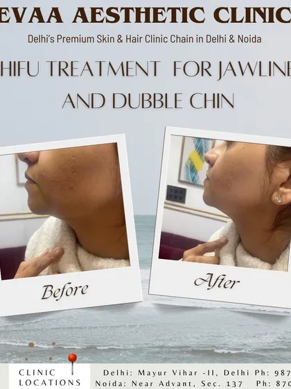 A clear before-and-after view of our HIFU treatment for jawline contouring and double chin reduction. This non-surgical procedure tightens skin and defines the facial profile with no downtime.