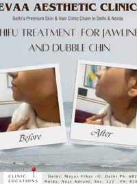 Skin Tightening & Non-Surgical Lifts