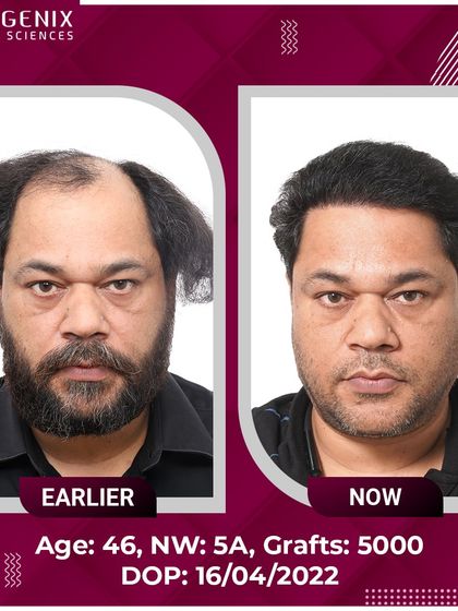 A remarkable 5000-graft transformation for a 46-year-old patient with Grade 5A baldness.