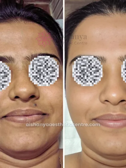 This client received a HydraFacial treatment, and the results are clear. Her skin in the 'after' photo is visibly brighter, more hydrated, and the overall tone is more even, showing the instant benefits of this popular facial.