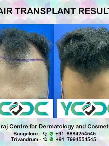 The purple marking shows the planned hairline before surgery. The after photo reveals a dense, natural hairline that perfectly matches the plan.