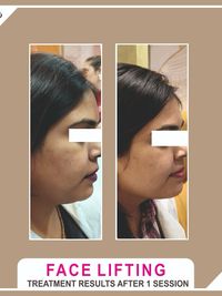 Anti-Aging & Face Contouring