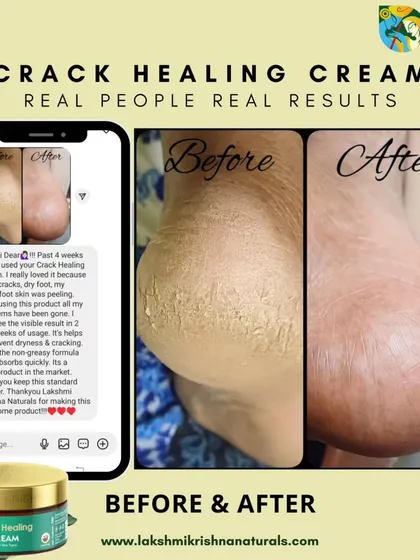 Real people, real results. This before-and-after image shows the effectiveness of our Crack Healing Cream in just four weeks, healing dry, cracked feet and restoring smooth skin.
