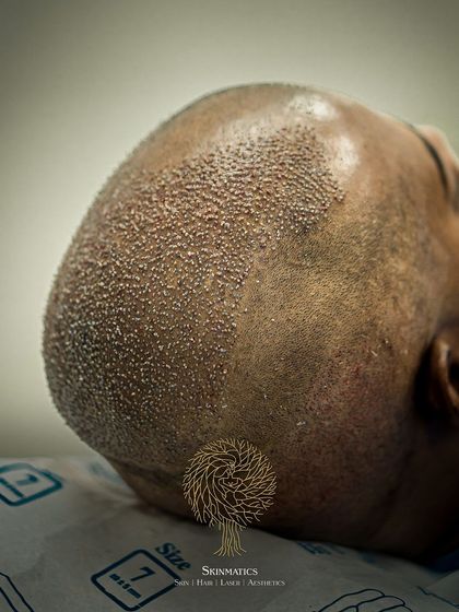 Skinmatics - Hair Restoration The FUE Transplant Process: A Step-by-Step Look photo 15