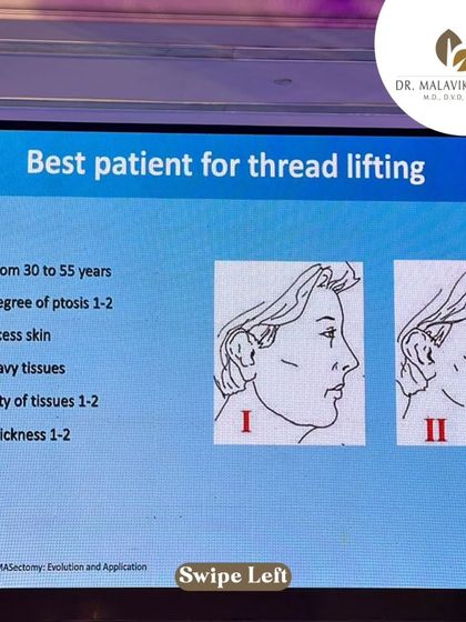 A slide from the Aptos Master Class detailing the ideal patient profile for thread lifting. Proper patient selection is key to achieving the best results.