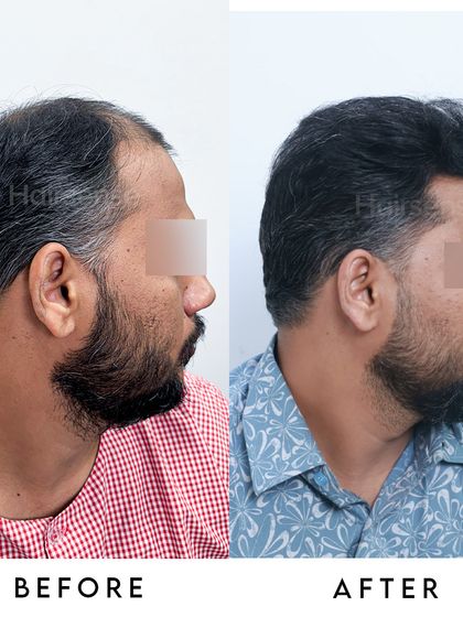 From the other side, you can see the consistent density and natural angle of the transplanted hair, ensuring a balanced look from all perspectives.