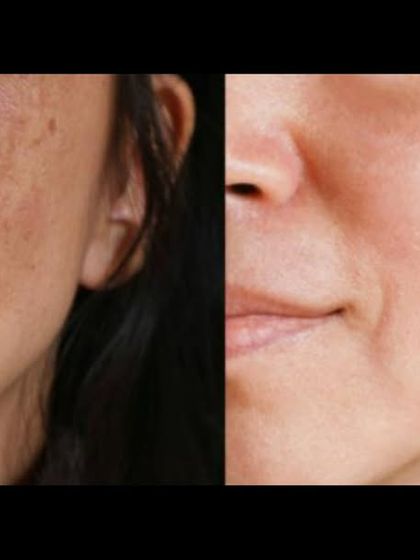 This transformation shows a significant lightening of facial pigmentation. I use a multi-pronged approach, combining in-clinic procedures with at-home care for the most effective and lasting results.
