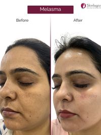 Facial Rejuvenation & Contouring