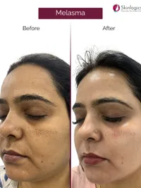 Skin Brightening & Pigmentation Treatment