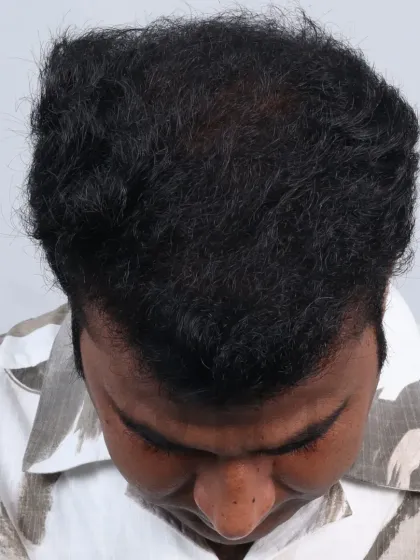 An incredible 5-month result for a diffuse grade 6 case. We used 4500 grafts to cover the frontal hairline, mid-scalp, and crown.