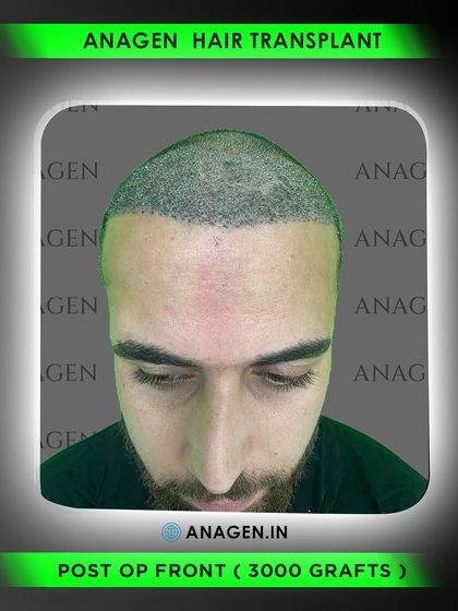 This is the immediate post operative result of a 3000 graft transplant. You can see the density and precision of the graft placement, which is the foundation for a great final result.