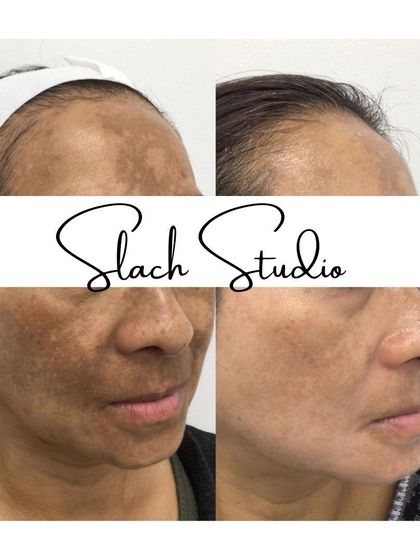 A comprehensive result showing the clearing of pigmentation on both the forehead and cheeks for a total transformation.