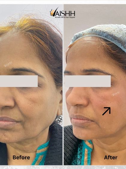 This before and after shows a cheek lift and treatment for sagging skin on a 55-year-old patient. The result is a visible lift and improved skin tautness.