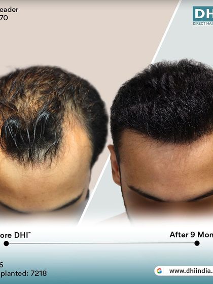 A top-down view of the 9-month result. This image clearly shows the significant improvement in coverage and density across the scalp, demonstrating the effectiveness of our DHI procedure.