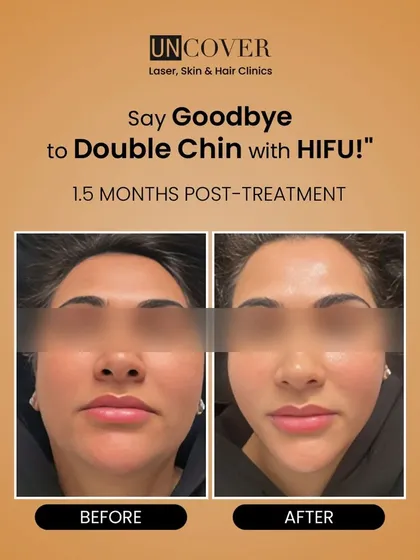 Here is a clear example of what HIFU can achieve. This client was concerned about her double chin, and these are the results just 1.5 months after her treatment. Notice the significant reduction in submental fat and the newly defined, sharper jawline. This is non-surgical fat reduction at its best.