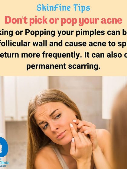 A crucial tip: do not pick or pop your pimples. This can push bacteria deeper, spread the infection, and lead to permanent acne scarring.