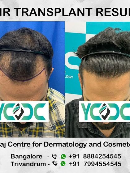 The hairline design is visible in the 'before' picture, and the 'after' shows how that plan was executed to create a dense, natural-looking result.