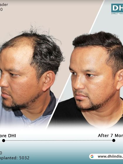 A side-profile view of the same client's 7-month progress. This angle highlights the natural-looking hairline and the seamless blend of the transplanted hair.