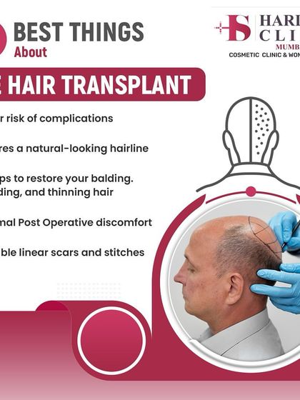 This graphic summarizes the five best things about the FUE hair transplant technique. It highlights the benefits like minimal discomfort, no linear scars, and the ability to restore a natural-looking hairline permanently.