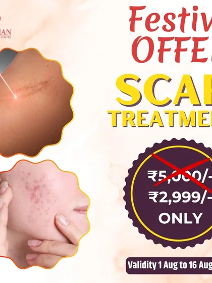 Don't miss this festive offer on scar treatments. Get a significant discount on procedures for both surgical and acne scars for a limited time.