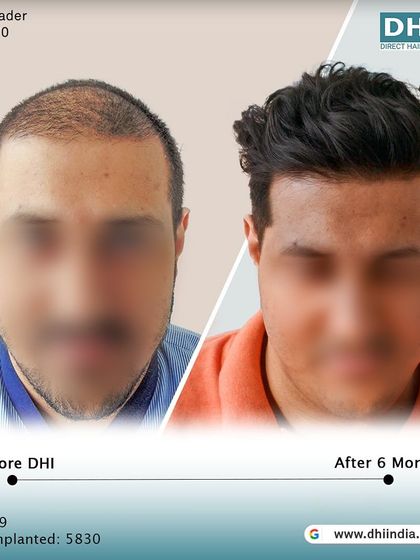 A frontal before and after of the 29-year-old client. The restored hairline and fuller look have given him a renewed sense of confidence just 6 months after his hair transplant.