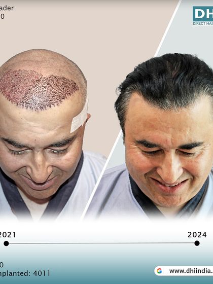 This image shows the client's head immediately after the procedure in 2021 compared to the full growth in 2024. It offers a transparent look at the journey from transplant day to a confident, long-term result.