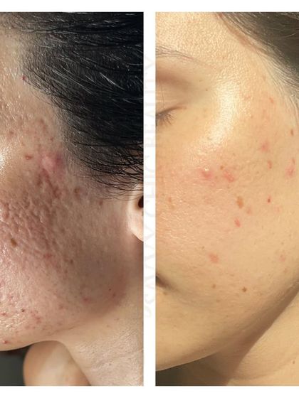 Deep, pitted acne scars require advanced treatments. This result was achieved using fractional laser therapy to stimulate deep collagen production and rebuild the skin's foundation.