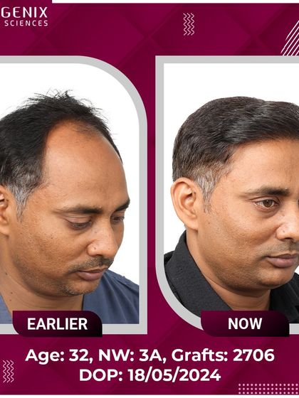 A 32-year-old patient's journey from Grade 3A baldness to a full, confident look after 2706 grafts.